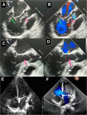 A rare morphology of the cardiac fibroma in a child: a case report